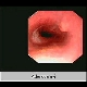 adenoca adenocarcinoma cancer of unknown primary prognosis pancreas or liver or bone
